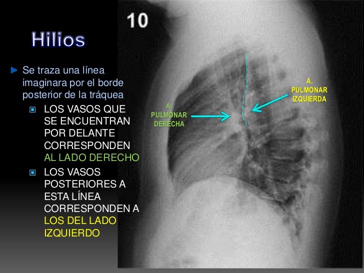 Interpretacion de radiografia PA de torax o tele de torax