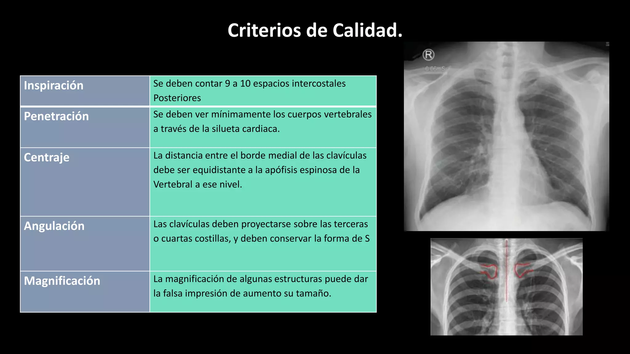 Torax Inestable Rx RX de torax.pptx | Lung and Respiratory Health | Diseases and Conditions