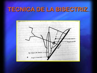 TECNICA DE LA BISECTRIZ.
 