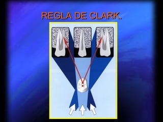 REGLA DE CLARK.
 