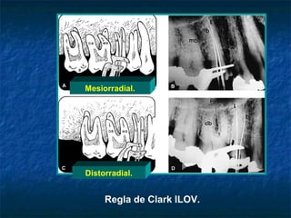 Mesiorradial.




Distorradial.


     Regla de Clark ILOV.
 