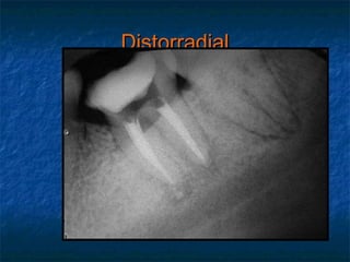 Distorradial
 