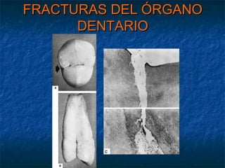 FRACTURAS DEL ÓRGANO
      DENTARIO
 