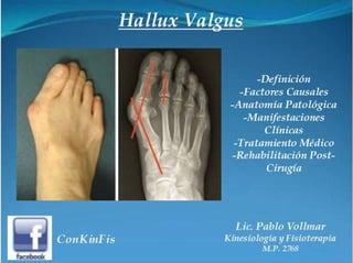 Hallux Valgus Tratamiento