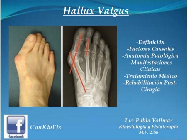 Hallux Valgus Tratamiento