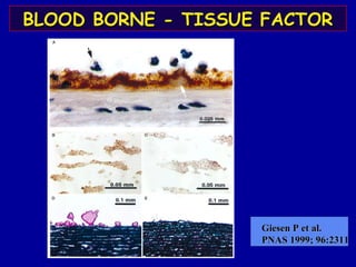 BLOOD BORNE - TISSUE FACTORBLOOD BORNE - TISSUE FACTOR
Giesen P et al.Giesen P et al.
PNAS 1999; 96:2311PNAS 1999; 96:2311
 