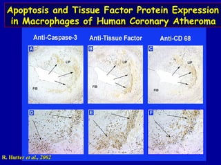 Apoptosis and Tissue Factor Protein ExpressionApoptosis and Tissue Factor Protein Expression
in Macrophages of Human Coronary Atheromain Macrophages of Human Coronary Atheroma
Apoptosis and Tissue Factor Protein ExpressionApoptosis and Tissue Factor Protein Expression
in Macrophages of Human Coronary Atheromain Macrophages of Human Coronary Atheroma
R. HutterR. Hutter et al., 2002et al., 2002
 