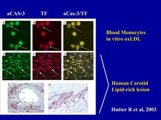 Blood MonocytesBlood Monocytes
in vitro oxLDLin vitro oxLDL
Human CarotidHuman Carotid
Lipid-rich lesionLipid-rich lesion
aCAS-3aCAS-3 TFTF aCas-3/TFaCas-3/TF
Hutter R et al, 2003Hutter R et al, 2003
 