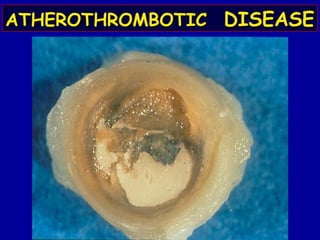 ATHEROTHROMBOTICATHEROTHROMBOTIC DISEASEDISEASE
 