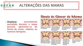  Displasia: normalmente
percebido durante o toque
pessoal, apresenta-se de
forma de cistos, nódulos ou
tumores benignos.
 