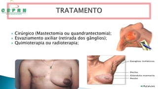  Cirúrgico (Mastectomia ou quandrantectomia);
 Esvaziamento axiliar (retirada dos gânglios);
 Quimioterapia ou radioterapia;
 