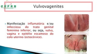  Manifestação inflamatória e/ou
infecciosa do trato genital
feminino inferior, ou seja, vulva,
vagina e epitélio escamoso do
colo uterino (ectocérvice).
 