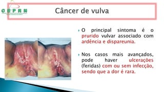  O principal sintoma é o
prurido vulvar associado com
ardência e dispareunia.
 Nos casos mais avançados,
pode haver ulcerações
(feridas) com ou sem infecção,
sendo que a dor é rara.
 