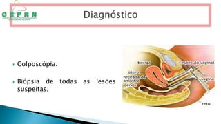  Colposcópia.
 Biópsia de todas as lesões
suspeitas.
 