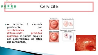  A cervicite é causada
geralmente por
sensibilidades a
determinados produtos
químicos, incluindo aqueles
nos espermicidas, no látex
das camisinhas.
 