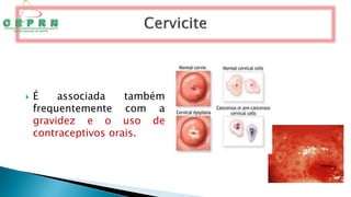  É associada também
frequentemente com a
gravidez e o uso de
contraceptivos orais.
 