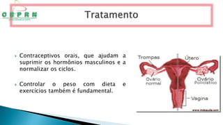  Contraceptivos orais, que ajudam a
suprimir os hormônios masculinos e a
normalizar os ciclos.
 Controlar o peso com dieta e
exercícios também é fundamental.
 
