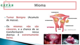  Tumor Benigno (Acumulo
de massa).
 Os miomas não são
cânceres, e a chance de se
transformarem nessa
doença é extremamente
baixa.
 