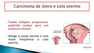  Tumor maligno, progressivo,
podendo evoluir para um
processo invasor.
 Atinge o corpo uterino e com
maior frequência o colo
uterino.
 