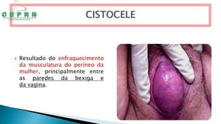  Resultado do enfraquecimento
da musculatura do períneo da
mulher, principalmente entre
as paredes da bexiga e
da vagina.
 