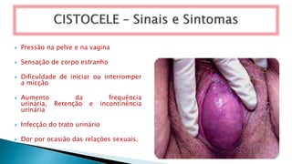  Pressão na pelve e na vagina
 Sensação de corpo estranho
 Dificuldade de iniciar ou interromper
a micção
 Aumento da frequência
urinária, Retenção e incontinência
urinária
 Infecção do trato urinário
 Dor por ocasião das relações sexuais.
 