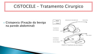  Cistopexia (Fixação da bexiga
na parede abdominal)
 