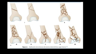 anatomia radiologica de rodilla, patologia degenerativa y traumatica | PPTX