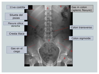 Colon En Rx Rx simple y contrastada de abdomen | PPTX