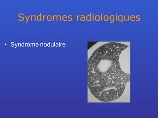 Syndromes radiologiques Syndrome nodulaire 