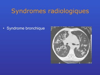 Syndromes radiologiques Syndrome bronchique 