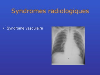 Syndromes radiologiques Syndrome vasculaire 