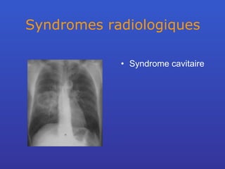 Syndromes radiologiques Syndrome cavitaire 