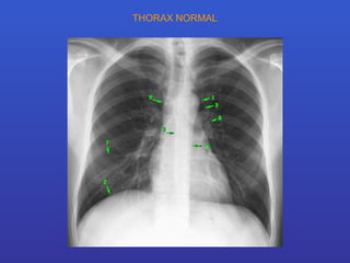 THORAX NORMAL 