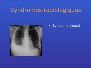 Syndromes radiologiques Syndrome pleural 