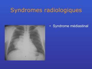 Syndromes radiologiques Syndrome médiastinal 