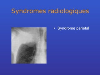 Syndromes radiologiques Syndrome pariétal 