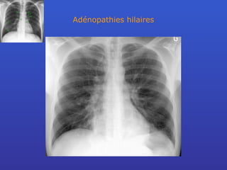 Adénopathies hilaires 