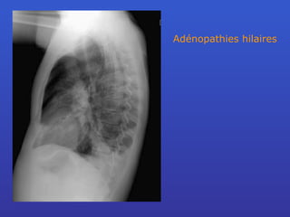 Adénopathies hilaires 