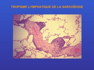 TROPISME LYMPHATIQUE DE LA SARCOÏDOSE 