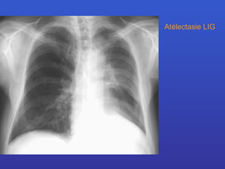 Atélectasie LIG 