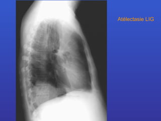 Atélectasie LIG 