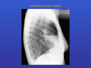 Atélectasie lobe moyen 