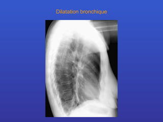 Dilatation bronchique 