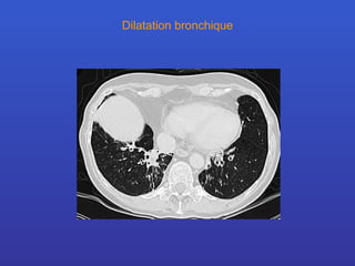 Dilatation bronchique 