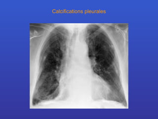 Calcifications pleurales 