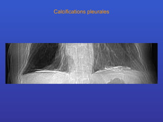 Calcifications pleurales 