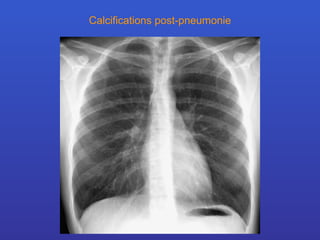 Calcifications post-pneumonie 