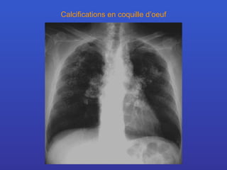 Calcifications en coquille d’oeuf 