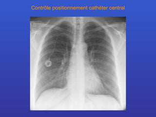 Contrôle positionnement cathéter central 