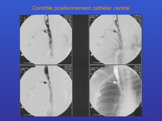 Contrôle positionnement cathéter central 
